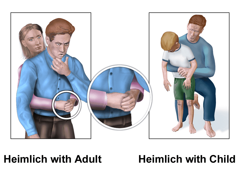 Heimlich Manoeuvre